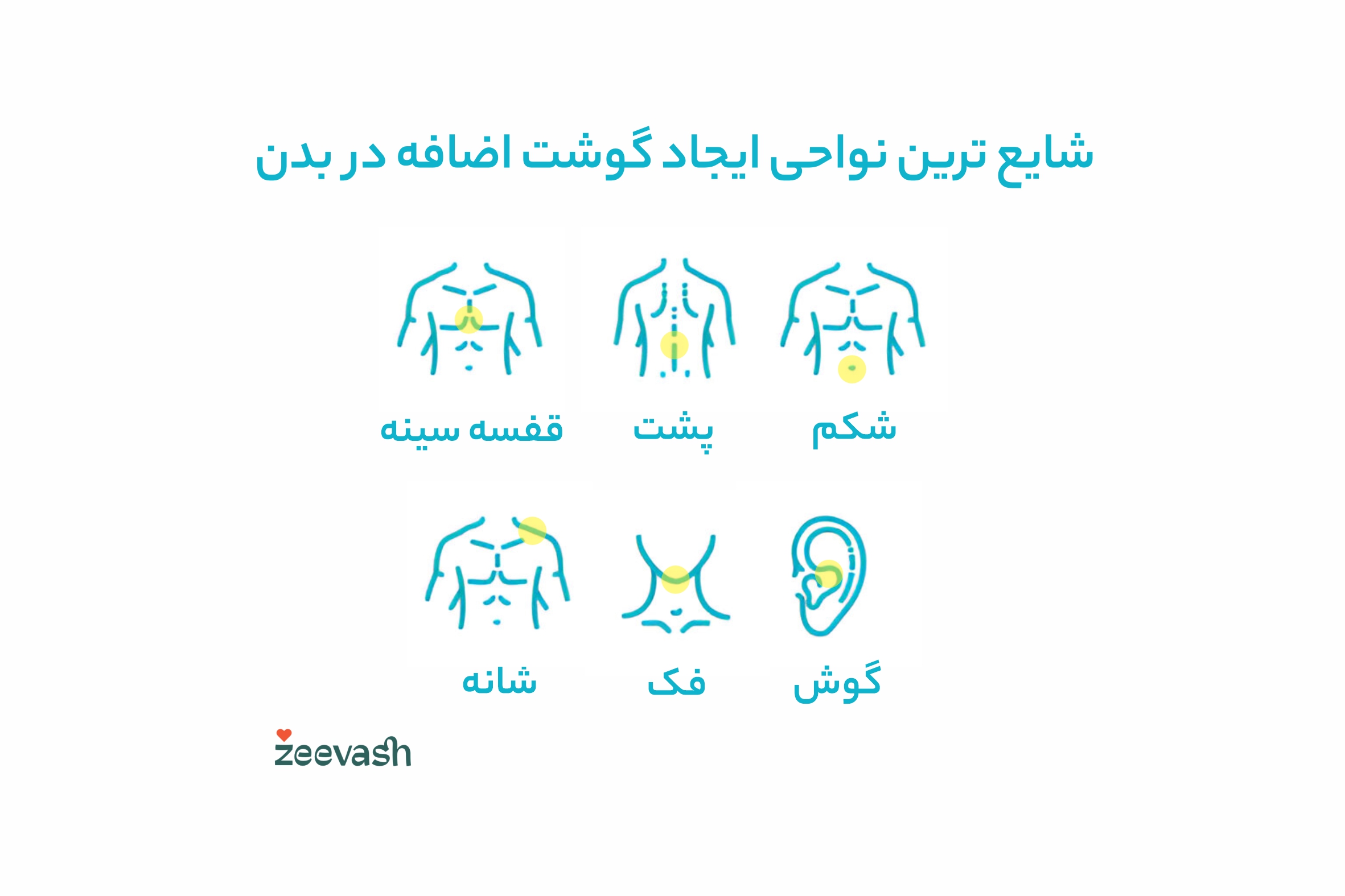 شایع ترین نواحی بروز گوشت اضافه در بدن